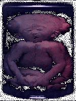 Pickled Punks, Circus Sideshow, Human Freaks